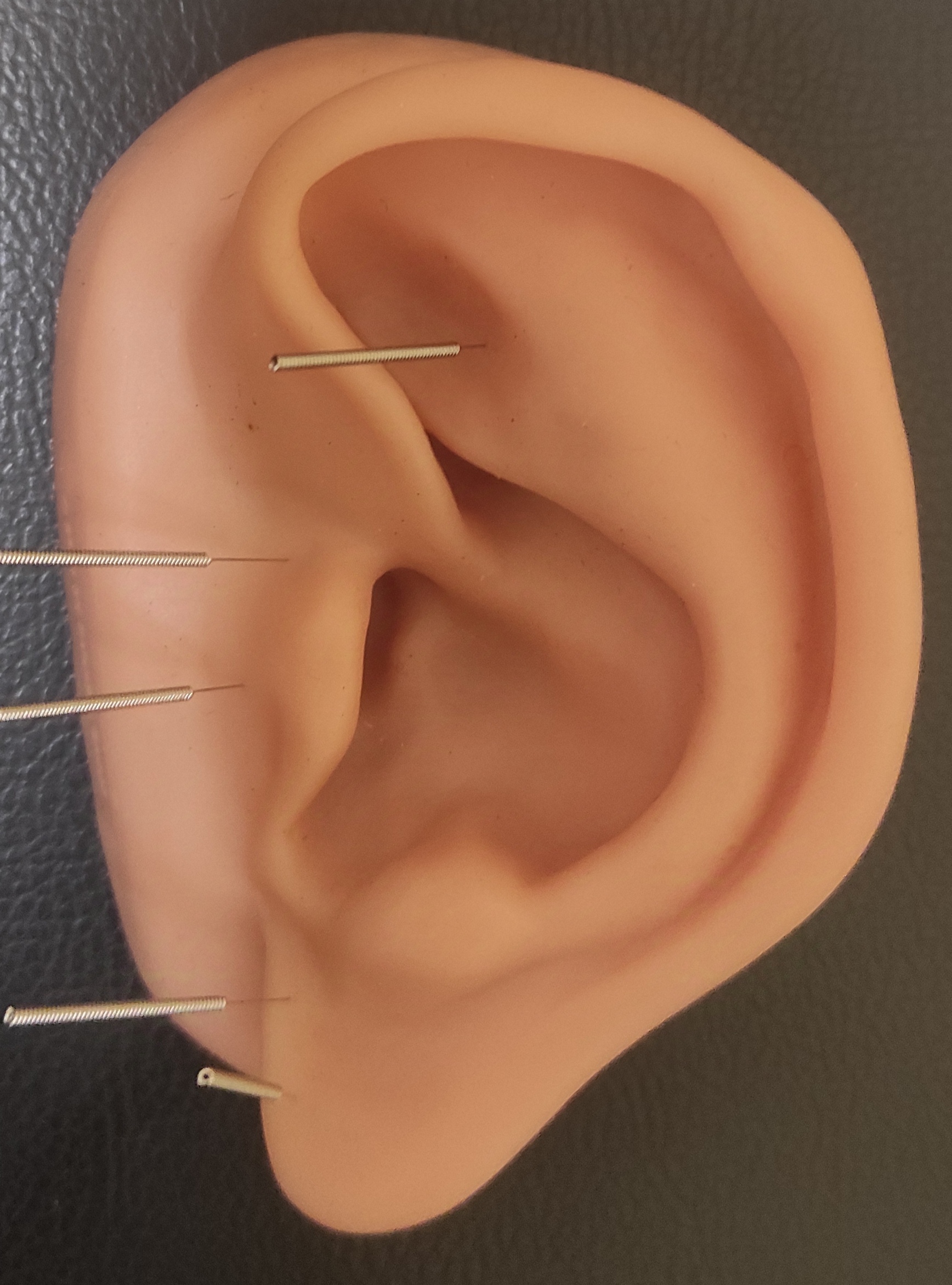 Auriculopuntura — acupuntura en la oreja
